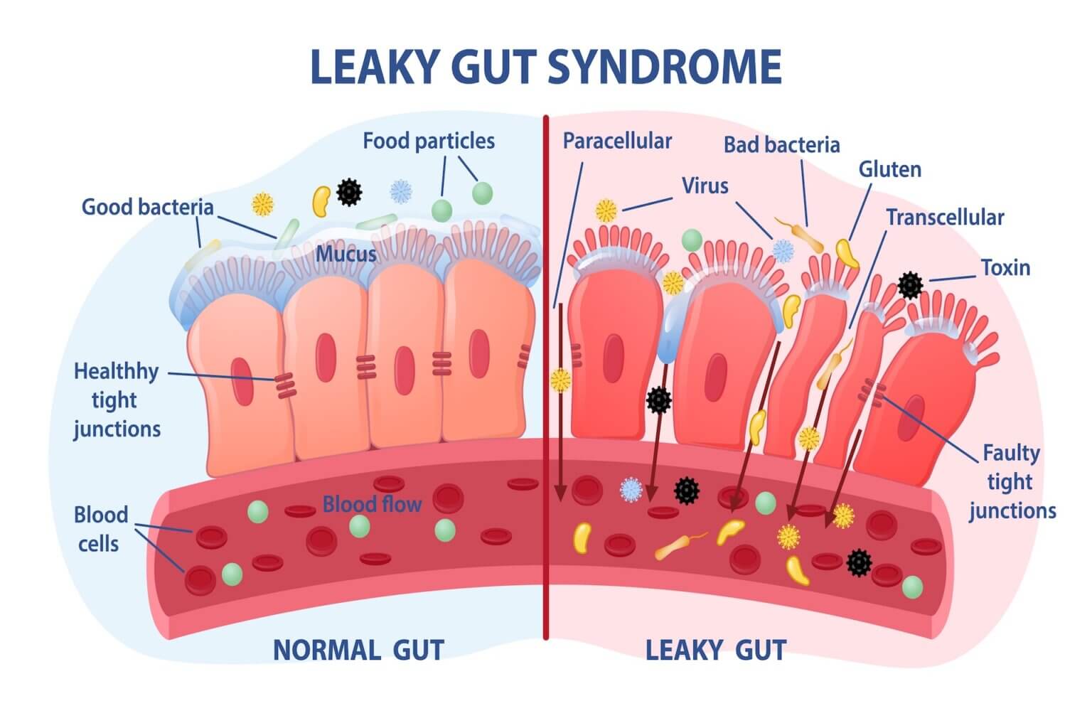 How Leaky Gut Affects Autoimmune Diseases The James Clinic Functional Doctor 
