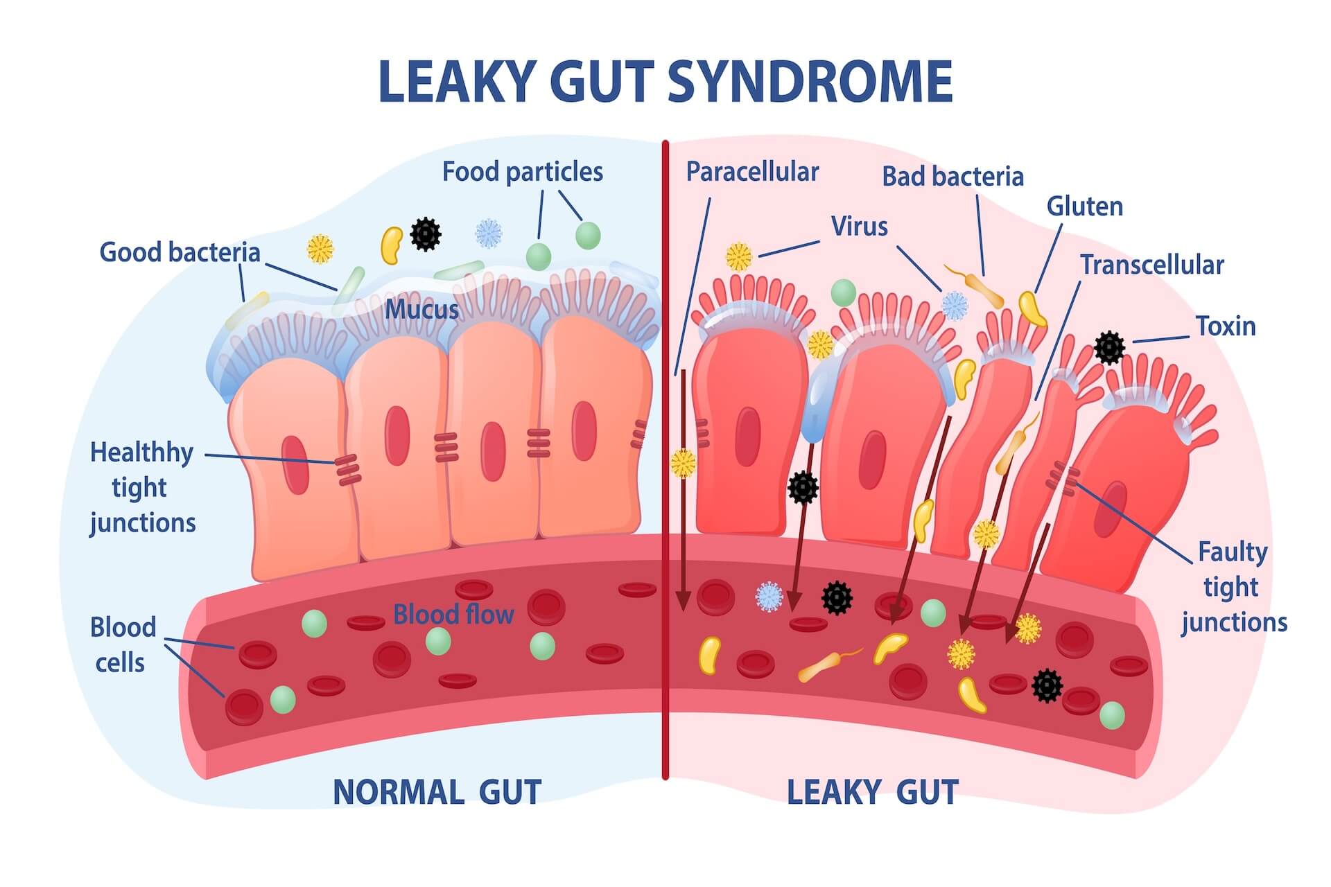 How Leaky Gut Affects Autoimmune Diseases